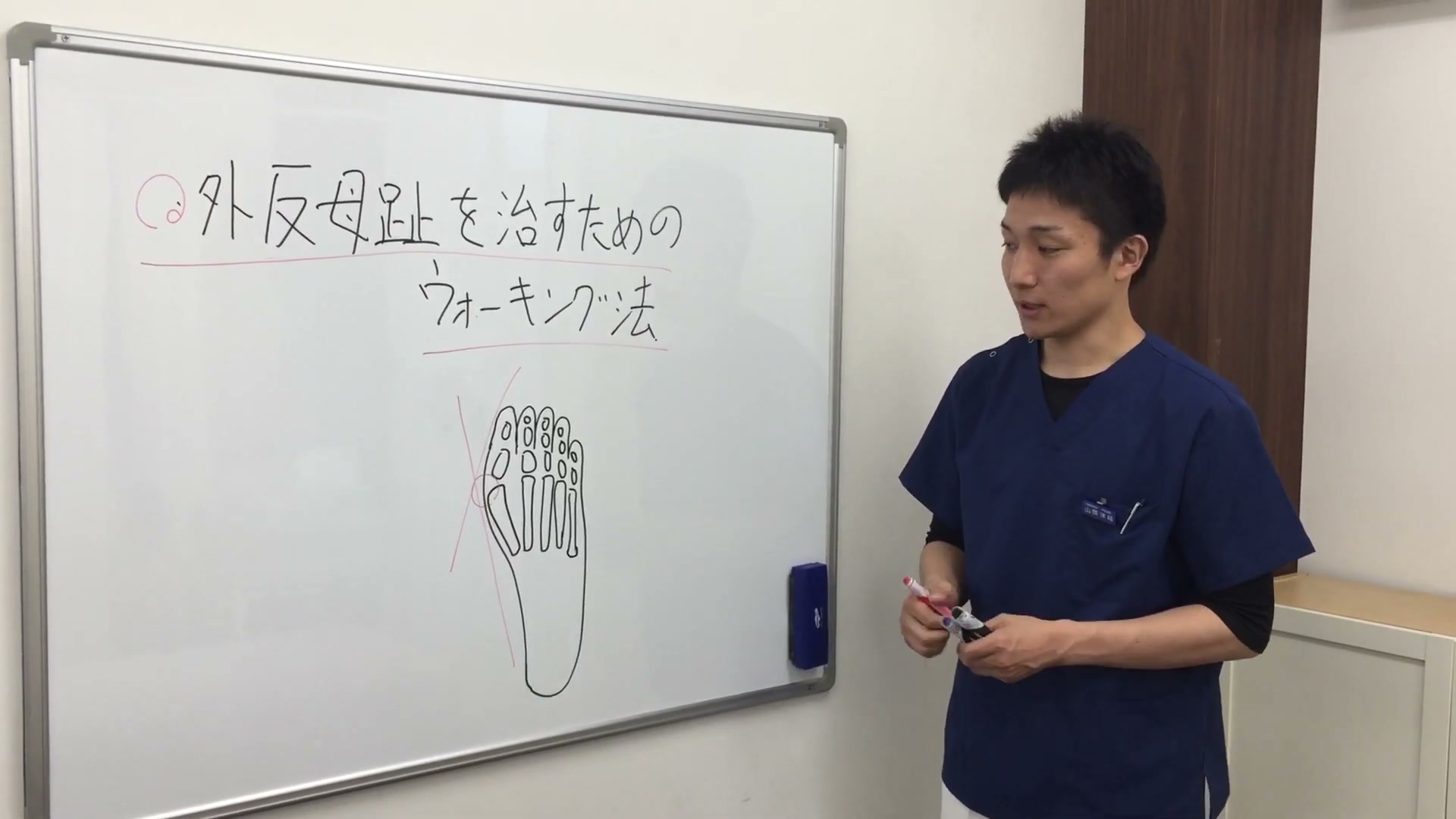 外反母趾はヒールなどで親指が外に向き横アーチが開くことを説明したホワイトボード