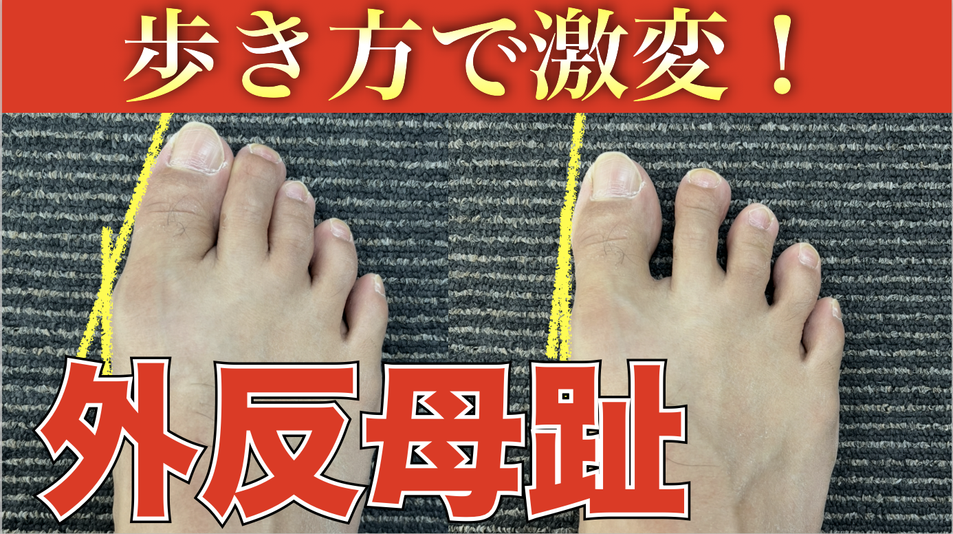 親指は犯人じゃない？外反母趾が進む人に共通する歩き方とおうちでできるセルフケア
